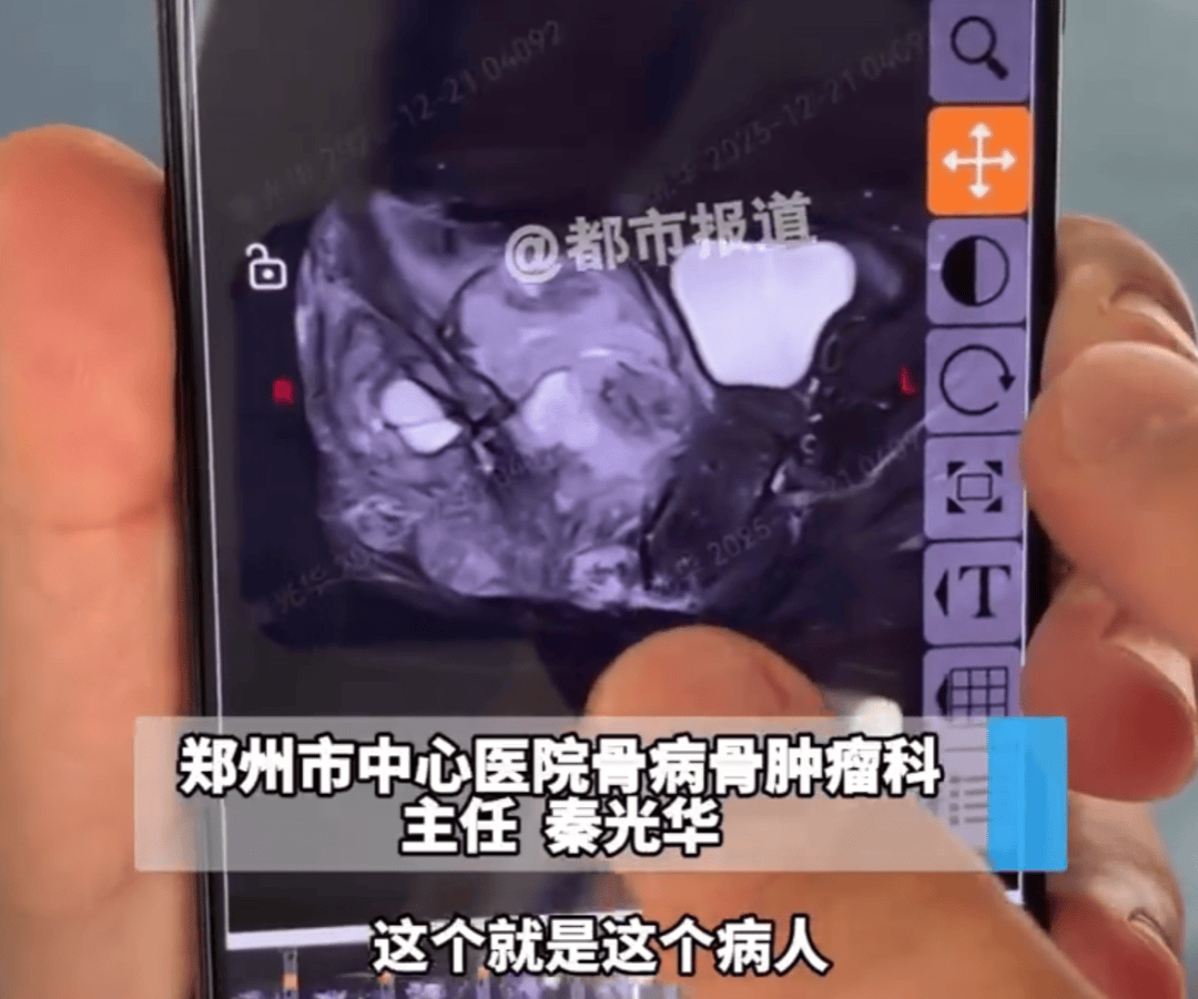 那可恩普拉托姆联vs查英特贺纳比尔_13岁女孩频繁屁股疼确诊骨癌那可恩普拉托姆联vs查英特贺纳比尔！或将截掉一侧屁股