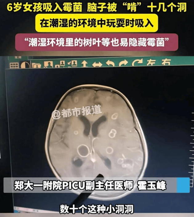皇冠信用网代理注册_6岁女童发烧17天皇冠信用网代理注册,脑子竟被“啃”出十几个洞!“元凶”家中很常见!
