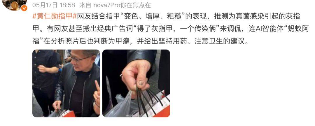 TianLu V BOA
_黄仁勋的指甲冲上热搜!高清镜头曝光TianLu V BOA
,网友吵翻!医生:这6种情况都可能
