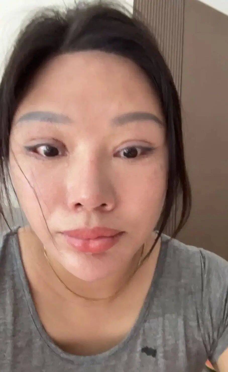 皇冠开户网址_“睡觉都是睁着眼” 皇冠开户网址,女子受老乡邀约,割双眼皮后无法闭眼,落下9级伤残,整形机构老板获刑后反起诉,女子被判退还20万元