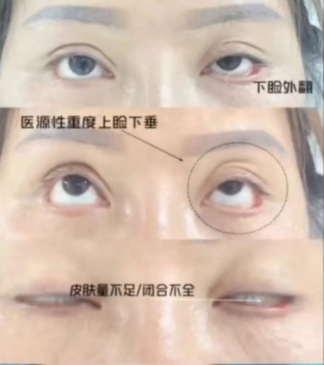 皇冠开户网址_“睡觉都是睁着眼” 皇冠开户网址,女子受老乡邀约,割双眼皮后无法闭眼,落下9级伤残,整形机构老板获刑后反起诉,女子被判退还20万元